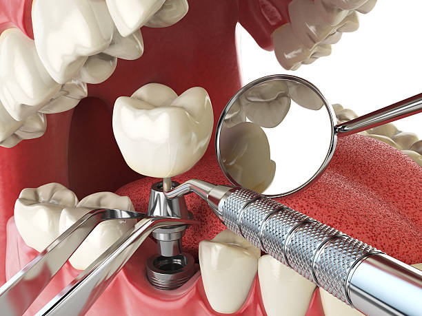 Best Emergency Wisdom Teeth Removal in Yacolt, WA